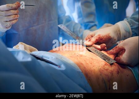 Nahaufnahme der Hände des Chirurgen in sterilen Handschuhen, die den Bauch des Patienten mit Lineal messen, während der plastischen Operation im Operationssaal. Konzept der Bauchstraffung und kosmetischen Chirurgie. Stockfoto