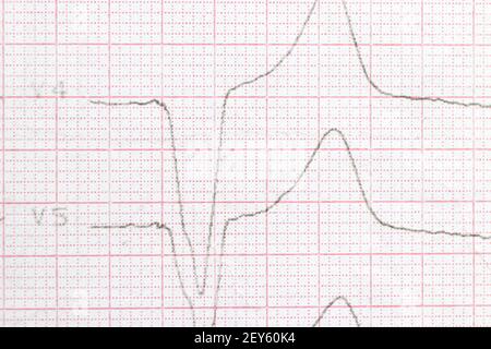 Makrofoto des EKG-Kardiogramms eines Patienten mit Herzinfarkt. Stockfoto