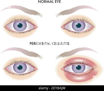 Die medizinische Illustration zeigt den Vergleich zwischen normalen Augen und den von periorbitaler Cellulitis betroffenen Augen. Stock Vektor