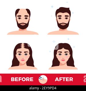 Mann und Frau vor und nach der Haartransplantation auf Weiß Hintergrund flache Vektorgrafik Stock Vektor