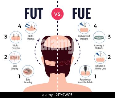 Methoden der Haartransplantation fut vs fue Poster mit Infografik Elemente auf weißem Hintergrund Vektordarstellung Stock Vektor