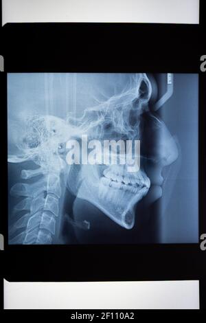 Laterale Radiographie der Halswirbelsäule und des Schädels. Dentale Radiographie. Röntgenaufnahmen eines jungen Mannes. Stockfoto