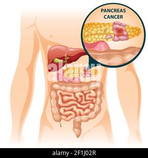 Cartoon Verdauungstrakt menschlichen Organen Konzept mit Leberdarm Magen und Vektorgrafik Pankreas krank Stock Vektor