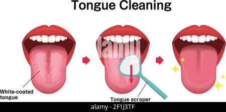 Wie Sie Ihre Zunge Vektorgrafik reinigen (Mundgeruch Prävention) Stock Vektor