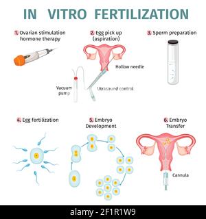 In-vitro-Fertilisation Konzept mit Schritten und Verfahren der künstlichen Vektorgrafik Insemination Stock Vektor