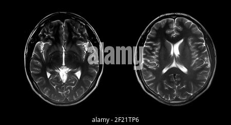 Magnetresonanzbild (MRT) des normalen Gehirns, Panorama-Hirntomographie Stockfoto