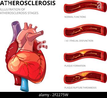 Atherosklerose. Bildung von faseriger Plaque. Medizinischer Mensch, Gesundheitsgrafik, Thrombus im Gefäß. Infografik zur Vektorgrafik Stock Vektor