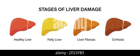 Stadien der nichtalkoholischen Leberschäden. Gesund, fettig und Zirrhose. Lebererkrankung. Stock Vektor