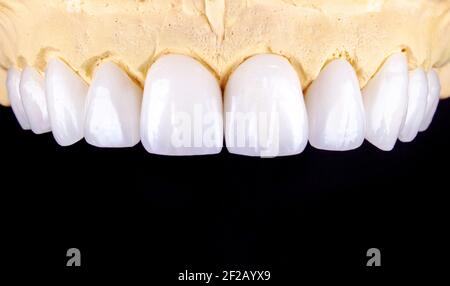 Perfektes Lächeln vor und nach Veneers Bleichmittel von Zirkon Bogen Keramik Prothesen Implantate Kronen. Zahnwiederherstellung Behandlung Klinik Patient. Ergebnis von Stockfoto