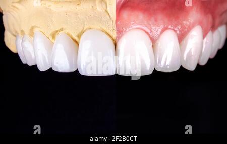 Perfektes Lächeln vor und nach Veneers Bleichmittel von Zirkon Bogen Keramik Prothesen Implantate Kronen. Zahnwiederherstellung Behandlung Klinik Patient. Ergebnis von Stockfoto