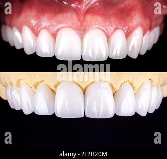 Perfektes Lächeln vor und nach Veneers Bleichmittel von Zirkon Bogen Keramik Prothesen Implantate Kronen. Zahnwiederherstellung Behandlung Klinik Patient. Ergebnis von Stockfoto