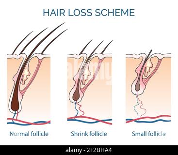 Haarausfall Schema. Verlust Haar, Wachstum Haar Problem, Gesundheit Haar. Vektorgrafik Stock Vektor