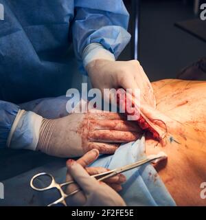 Medizinische Mitarbeiter Durchführung Bauchstraffung Chirurgie in der Klinik. Stockfoto