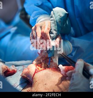 Plastischer Chirurg, der in der Klinik eine Bauchstraffung durchführt. Stockfoto