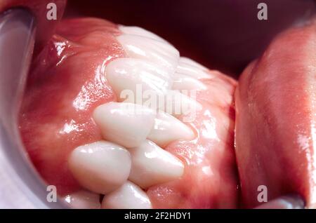 Perfekte Lächeln Chirurgie Veneers Bleichmittel von Zirkonbogen keramische Prothesen Implantate Kronen. Zahnwiederherstellung Behandlung Klinik Patient. Ergebnis der oralen Pro Stockfoto