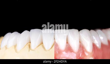 Perfektes Lächeln vor und nach Veneers Bleichmittel von Zirkon Bogen Keramik Prothesen Implantate Kronen. Zahnwiederherstellung Behandlung Klinik Patient. Ergebnis von Stockfoto