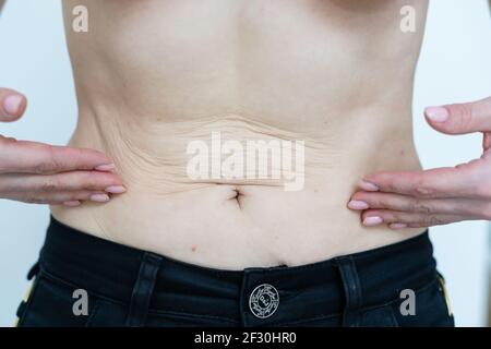 Nahaufnahme einer Frau, die auf ihrem Bauch mit schlaffe Haut zeigt. Gesundheitskonzept. Stockfoto