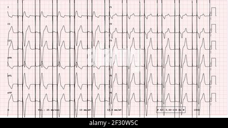 EKG-Beispiel für einen Schrittmacher-Rhythmus mit 12 Ableitungen und Schrittmacherspitze Stockfoto