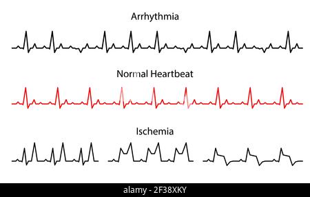 Einstellen der Linien Herzschlag normal, Arrhythmie und Ischämie. Linienkardiogramm Herz auf weißem Hintergrund. Vektorgrafik. Elektrokardiogramm Stock Vektor