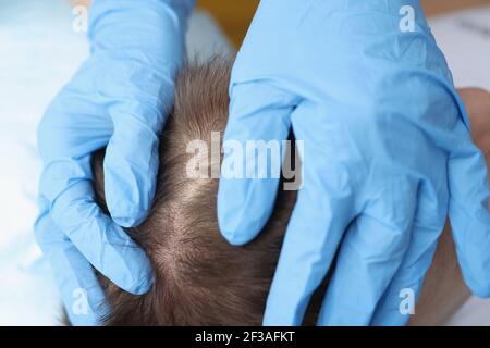 Arzt in Schutzhandschuhen Untersuchung der Haut auf Patienten Kopf Nahaufnahme Stockfoto