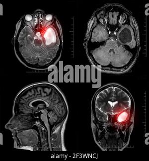 Magnetresonanztomographie eines Patienten mit einer temporalen Hornzyste des linken lateralen Ventrikels des Gehirns. Atrophische Veränderungen im Temporallappen. A Stockfoto