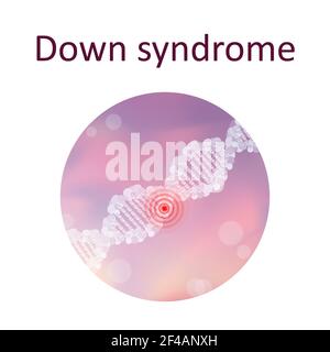 Down-Syndrom, Illustration Stockfoto