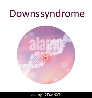 Down-Syndrom, Illustration Stockfoto