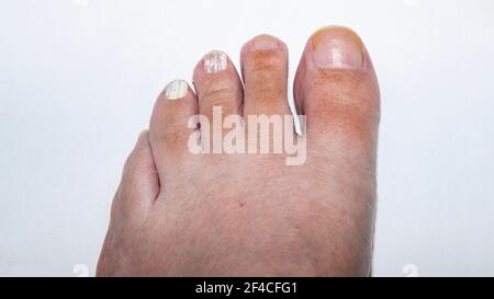 Linker Fuß mit Nagelpilz auf zwei Zehen Stockfoto