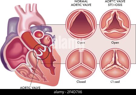 Medizinische Abbildung zeigt den Unterschied zwischen einer normalen Aortenklappe und einer mit Stenose, offen und geschlossen, und ihre Lage im Herzen, mit einem Stock Vektor