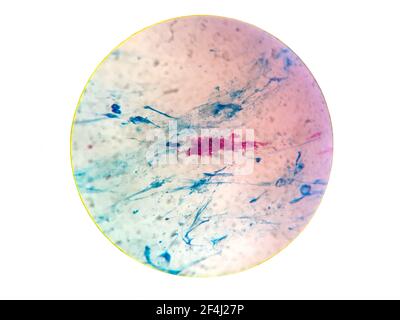 Nahaufnahme Gram Fleck Test zeigt Bakterienzellen von Tuberkulose Bakterien gram positiv auf Sputum isoliert auf weißem Hintergrund und Rauschen .gespeichert mit c Stockfoto