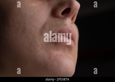 Herpes auf den Lippen, eine Frau mit einer Wunde auf der Lippe Stockfoto