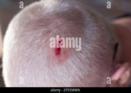 Verletzung der Kopfhaut. Blut tritt aus einer gehackten Wunde auf dem Kopf eines blonden Mannes wegen herabfallender Metallverstärkung aus. Nichtbeachtung der Sicherheit .precaut Stockfoto