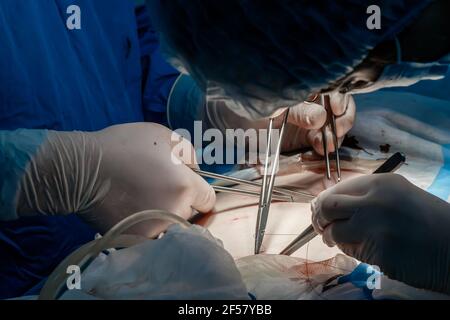 Ärzte verwenden medizinische Instrumente und Metallfäden, um die menschliche Haut während der minimal-invasiven Chirurgie zu nähen. Nahaufnahme der Hände in sterilen Handschuhen, abgedeckt Stockfoto