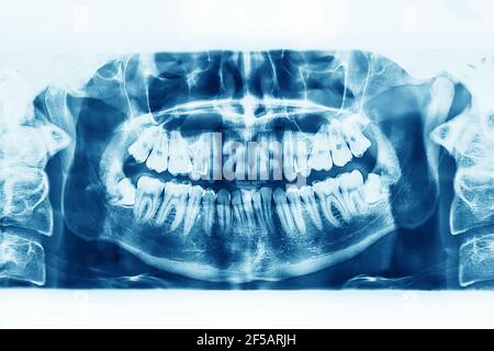 Röntgenbild der Mundhöhle mit wachsenden unteren Weisheitszähnen auf weißem Hintergrund. Stockfoto