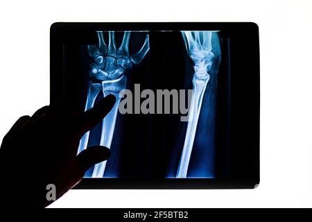 Der Arzt überprüft die Radiographie und untersucht den Röntgenfilm des Arms des Patienten, der auf eine Radiusfraktur zeigt. X-gerönte menschliche Hand. Röntgenaufnahme der Handknochen. Medizinischer Techno Stockfoto