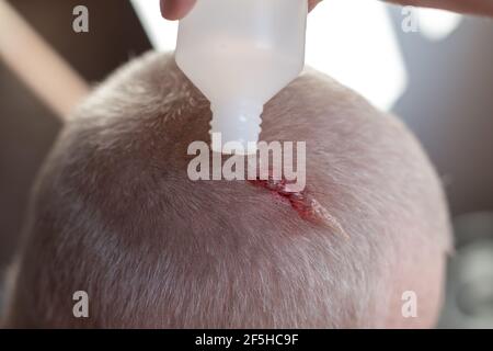 Verletzung der Kopfhaut. Blut tritt aus einer gehackten Wunde auf dem Kopf aus. Die Krankenschwester behandelt die Wunde mit Wasserstoffperoxid. Erste Hilfe. Stockfoto