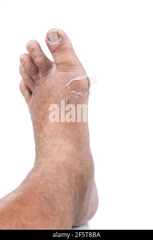 Das Fußgelenk wurde von Gicht-Attacke wiederhergestellt, wobei sich die alte Haut von der entzündlichen Stelle ablöste. Stockfoto