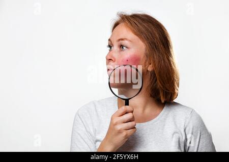 Das Konzept der Rosacea. Porträt einer kaukasischen Frau, die Rötung auf ihren Wangen zeigt, mit einer Lupe. Speicherplatz kopieren. Weißer Hintergrund. Stockfoto