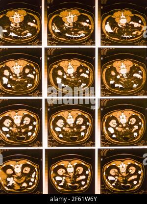 Abdominal CT Stockfoto