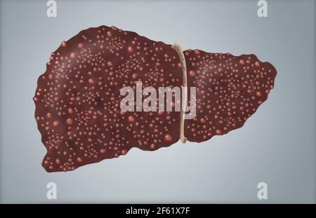 Illustration der zirrhotischen Leber Stockfoto