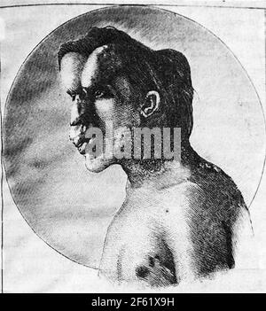 Joseph Merrick, der Elefantenmensch Stockfoto