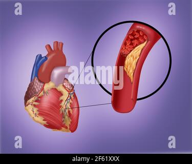 Thrombose in der Koronararterie Stockfoto