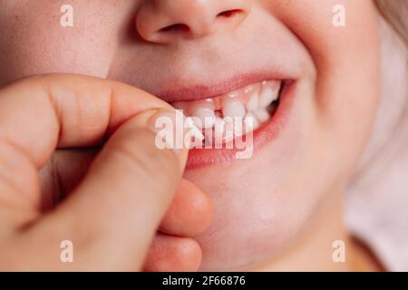 Nahaufnahme die Hand des Arztes hält den ersten abgefallenen Babyzahn In der Nähe der Wunde auf der unteren Zähnereihe von Der offene Mund des Kindes Stockfoto