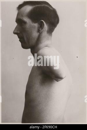 Fotografie aus "Beschreibung der Herstellung in der Zahnarztwerkstatt der Staatsbahn in Nässjö", 1932.Mann mit Amputearm, um eine Prothese aus der Prothesenwerkstatt in Nässjö zu erhalten. Stockfoto
