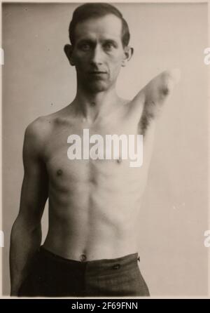 Fotografie aus "Beschreibung der Herstellung in der Zahnarztwerkstatt der Staatsbahn in Nässjö", 1932.Mann mit Amputearm, um eine Prothese aus der Prothesenwerkstatt in Nässjö zu erhalten. Stockfoto