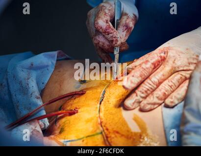 Plastischer Chirurg schneidet den Bauch des Patienten während der Bauchstraffung. Stockfoto