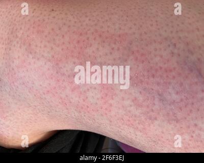 Fleckiger Hauthitzeausschlag Nesselsucht allergische Reaktion auf Nahaufnahme des Knies Referenzbild von fleckig fleckig rot gefärbtem Hauterythem ab igne, auch bekannt als EAI Stockfoto