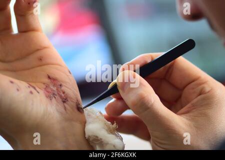 Abschürfungen an der Handfläche und Kratzer am rechten Arm eines erwachsenen Mannes. Behandlung zu Hause. Stockfoto