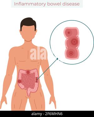 Vektor-Illustration für entzündliche Darmerkrankungen isoliert auf weißem Hintergrund Stock Vektor