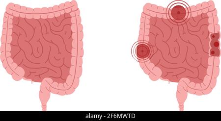 Flache Vektordarstellung von gesunden Eingeweiden und Eingeweiden mit entzündlichen Erkrankungen. Stock Vektor